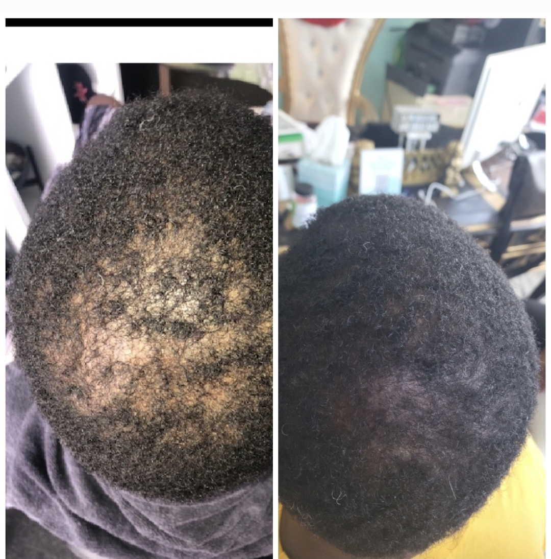 Approved client comparison: crown photographed before on the left and after on the right.