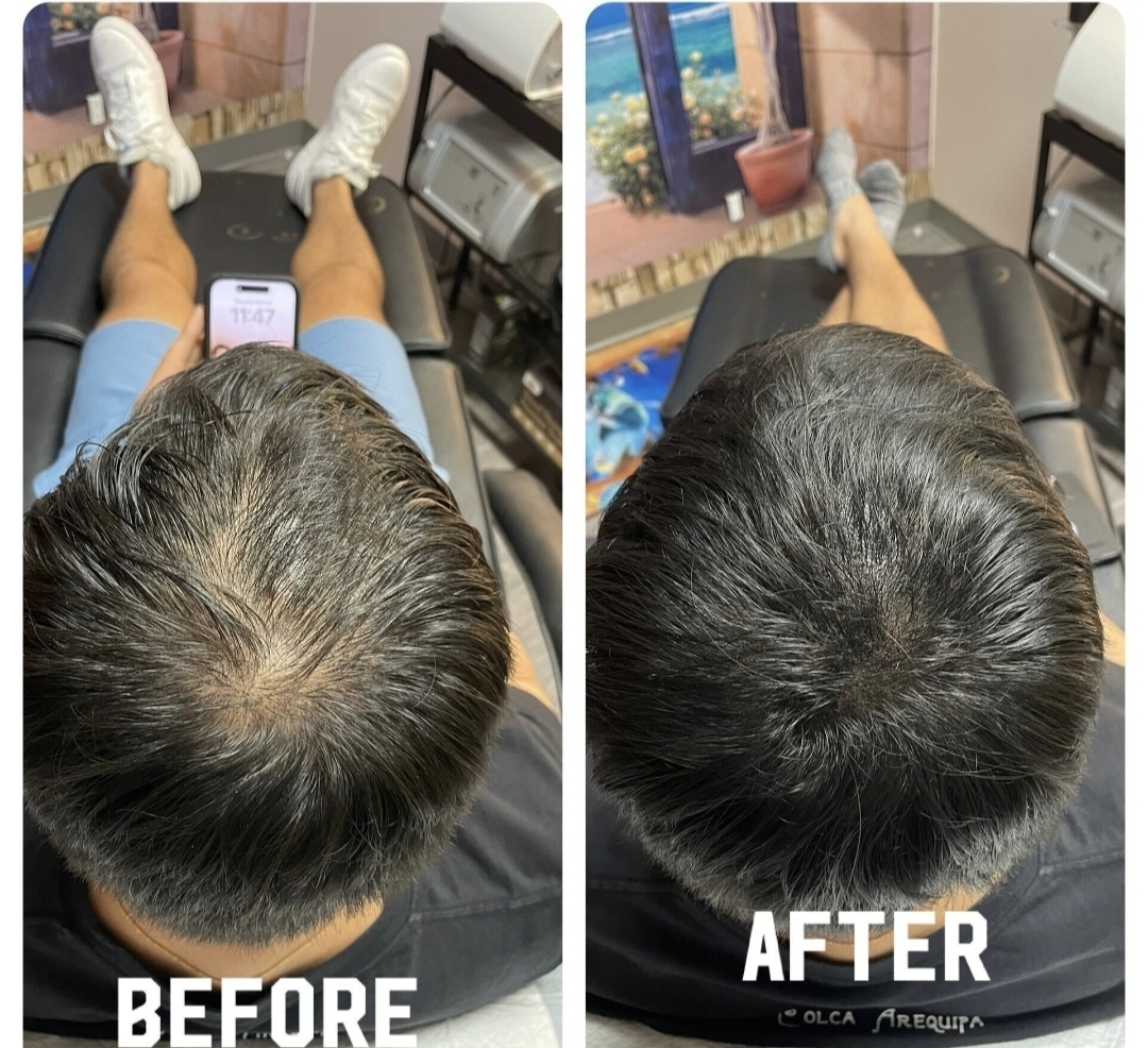 Approved client comparison: crown photographed from above before on the left and after on the right.