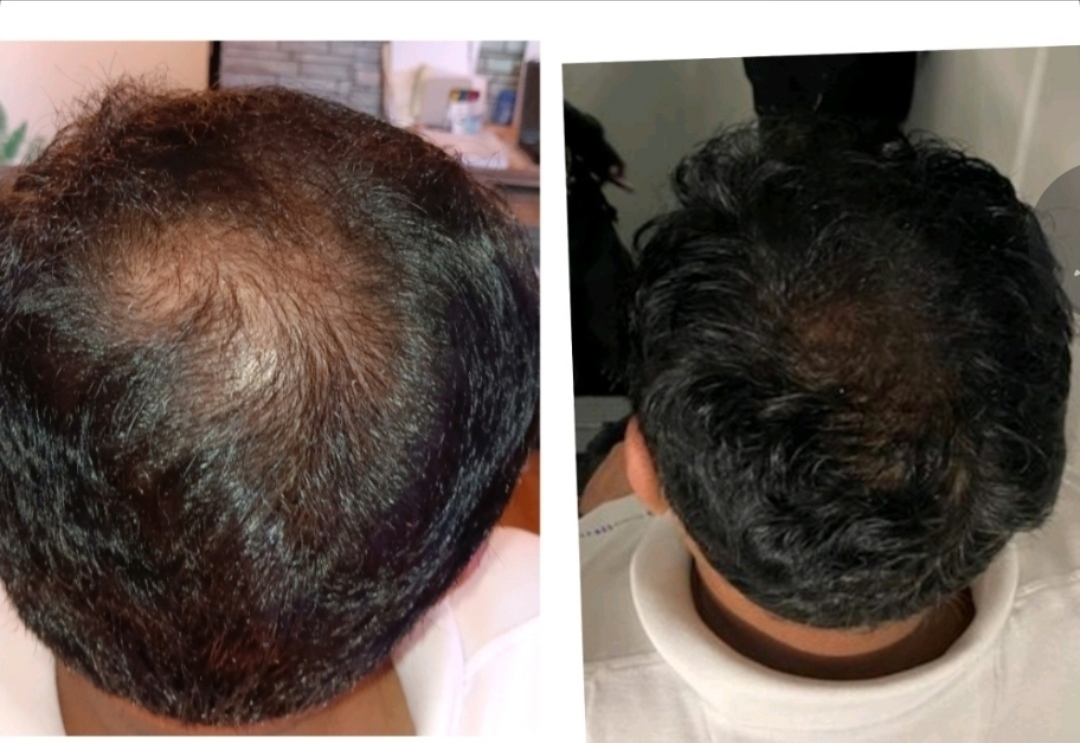 Approved client comparison: crown and back of short hair photographed before on the left and after on the right.